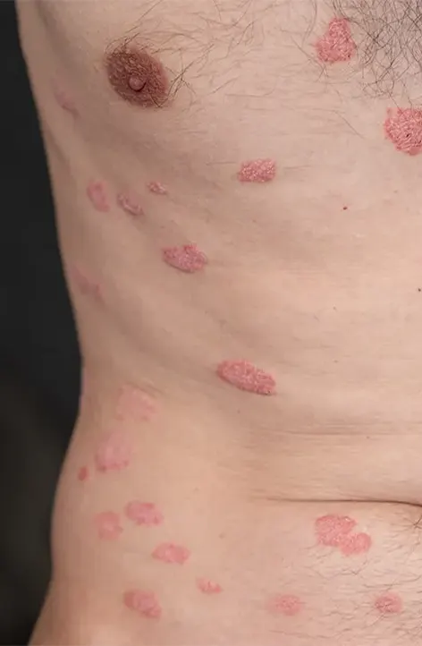 dislipidemia dottoressa linda casillo nutrizionista bastia umbra 1